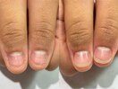 自爪風だから隠さずに深爪矯正