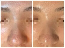 オリーブ コクブンジ(Olive kokubunji)/ハーブピーリング｜毛穴