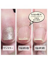 ミミカケルソラ(mimi×sora)/巻き爪補正☆ワンカラー