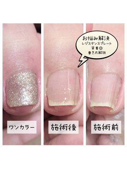 ミミカケルソラ(mimi×sora)/巻き爪補正☆ワンカラー