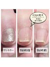 巻き爪補正☆ワンカラー