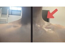 エミニーライフ(EMINY LIFE)/瞬間小顔★1回ビフォーアフター