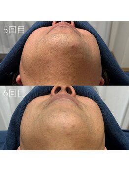 カナウ(KANAU)/ヒゲ脱毛（40代前半男性）