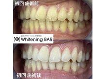 ホワイトニングバー 金沢フォーラス店/初回ビフォーアフターをご紹介