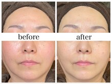 アリエス/肌質改善［赤ら顔/くすみ］