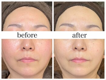 アリエス/肌質改善［赤ら顔/くすみ］