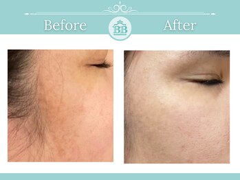 シミケアゼロ美人 表参道店(シミケアZERO美人)/【シミケア★シミゼロ症例】