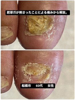 痛みの原因は肥厚爪が刺さり。