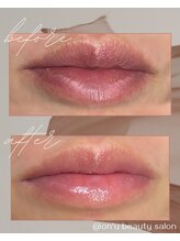 オンユ(ON’U)/【ローマピンク】before &nbsp;after