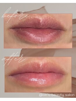 オンユ(ON’U)/【ローマピンク】before after