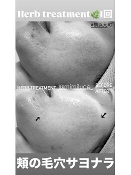 ミミルーチェ(mimiluce)/ハーブピーリング横浜《水光肌》