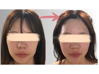 リズ(rE:S)/PDRNリジュランで美白!20代半ば