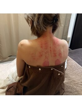 ソルーナ(So-Luna)/カッサ療法