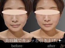 チョコバリ 恵比寿店(chocobari)/小顔リフトアップ（美容鍼）20代