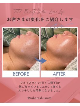 ルアナライフ(Luana Life)の写真/小顔リンパマッサージで憧れのフェイスラインへ！スッキリ二重アゴ、たるみ毛穴もケアし老け見え改善◎