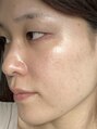 ハミングスキン(Humming skin)&nbsp;お肌が安定してきた頃。ノーメイク、無加工です。