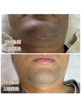 フェリス(FELIZ)/人気のヒゲ脱毛