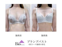 バイオビューティー 神戸本店(Bio Beauty)/プランプバスト　6回コース症例
