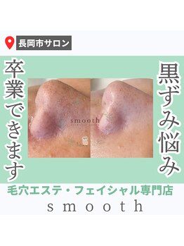スムース(smooth)/毛穴エクストラクション