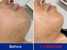 ミスターアンクール 鹿児島(Mr.uncoeur)/ヒゲ脱毛5回後