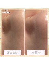 ウィズリリナ 新横浜(with Lilina.)/1回/毛穴洗浄/ハイドラ/新横浜