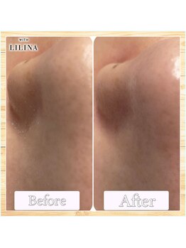 ウィズリリナ 新横浜(with Lilina.)/1回/毛穴洗浄/ハイドラ/新横浜