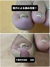 巻き爪施術|痛み変形の改善法