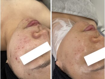 サロン ド ビューティージュエル(salon de beauty JEWEL)/光フェイシャル