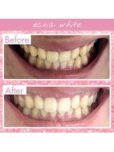 エクシアホワイトニング 西尾店/ビフォーアフター