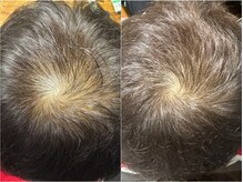 ルーナ 恵比寿(Luna)/ヘアロペーシア 男性症例