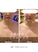 スリーウェルスラボ 恵庭店(THREE wealth lab)/小顔メニュー症例