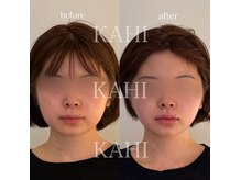 カヒ 札幌駅前(KAHI)の雰囲気（30代女性｜1回でここまで変化◎マイクロウェーブリフト症例）
