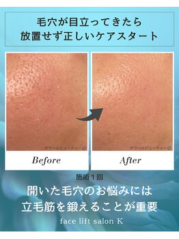 ケー(K)の写真/毛穴の悩みお任せください♪たるみ毛穴を改善する最新技術『表皮立毛筋リフト』で目指す理想のなめらかな肌