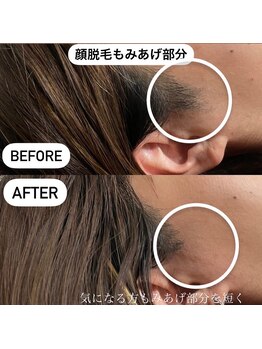 ココ(Coco)/脱毛(もみあげ)