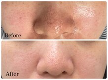 ル シェリア(Le Cherien)/たるみ毛穴ケアにはコレが効果的