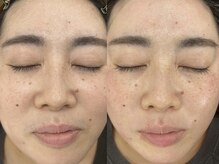 リコ バイ グラス(Rico by GRASS)/お顔全体のフェイシャルWax