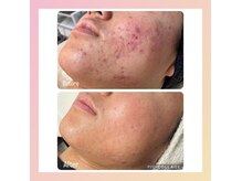 コンフィデンスサロン(Confidence Salon)の雰囲気（【数年間お悩みだった凹凸とニキビもしっかりケア★】）