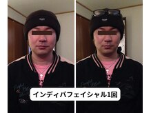 ランネル(Runnel)/インディバビフォーアフター