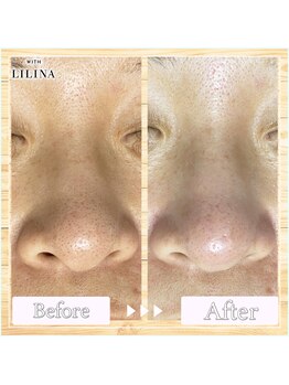 ウィズリリナ 新横浜(with Lilina.)/1回/毛穴洗浄/ハイドラ/新横浜