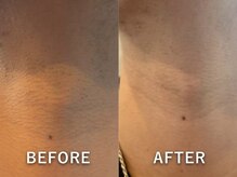 ビークリア(B.clear)