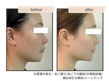 コンビンス(convince)/小顔【医療提携】脂肪分解剤導入