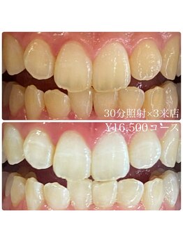 ホワイトニングルーム 横浜店(Whitening Room)/セルフホワイトニング/横浜