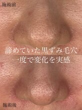 ルーモアンド(Lumo&)/毛穴ケア