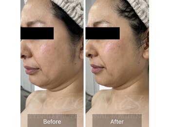 ユフラ(Juhla)/【切らない小顔リフト】