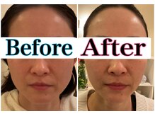 トータルビューティーサロン 凛/小顔＆リフトアップ