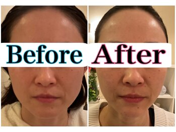 トータルビューティーサロン 凛/小顔&リフトアップ