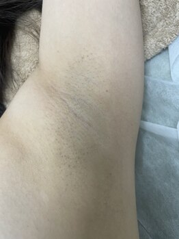 ナノハナ/鹿沼市の全身脱毛のナノハナ