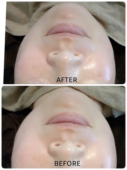 エムブルーム(m-bloom)/ホットストーンフェイシャル♪