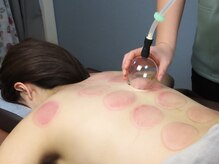 はりめぐり/【NEW】筋膜スライドカッピング