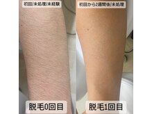 クレール 小山店(CLAIR)/【全身脱毛】